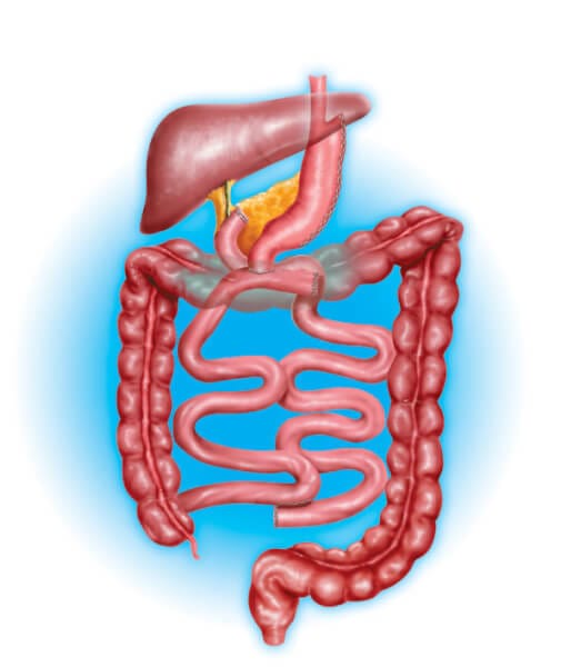 duodenal-switch-procedure.jpg