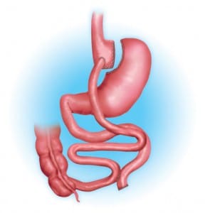 gastric-bypass-procedure.jpg