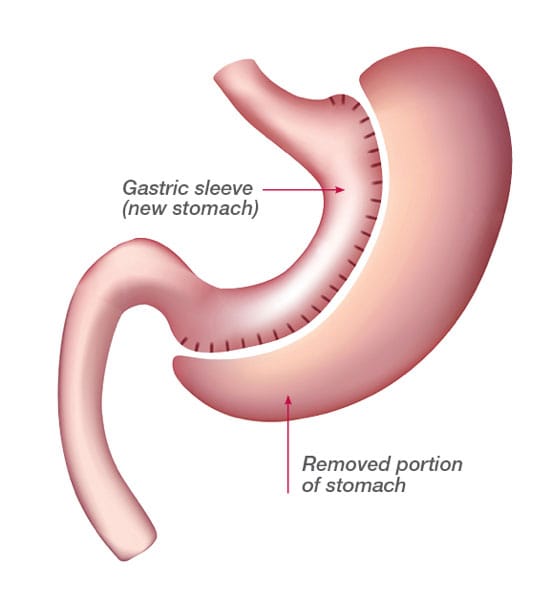 bariatric-vertical-sleeve.jpg