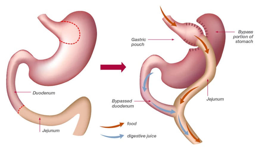 roux-eny-gastric-bypass.jpg