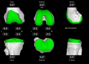 mako_total_knee_3d_planning.jpg